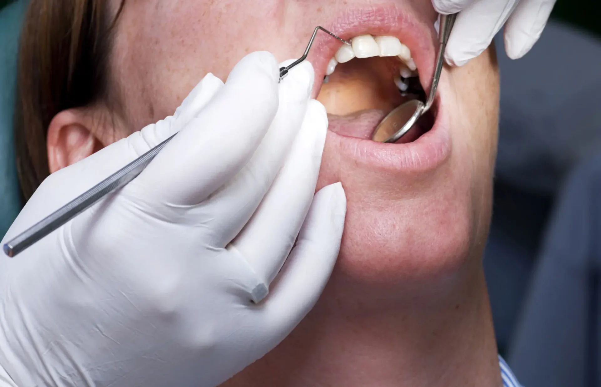 Patient receiving dental exam with mirror and probe